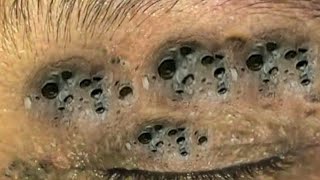 Big Cystic Acne Blackheads Extraction Blackheads amp Milia Whiteheads Removal Pimple Popping  5690 [upl. by Arriaet972]