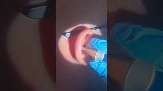 Earigator vs forceps round 2…fight earwaxremoval extraction earwax satisfying ears [upl. by Nylimaj115]