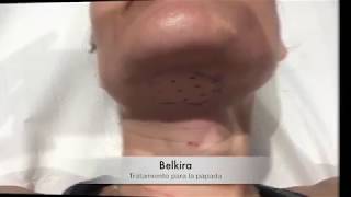 Belkyra  Eliminación de papada sin cirugía  Dermaforyou [upl. by Cirtemed]