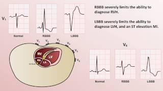 Intro to EKG Interpretation  Bundle Branch Blocks [upl. by Assetnoc]