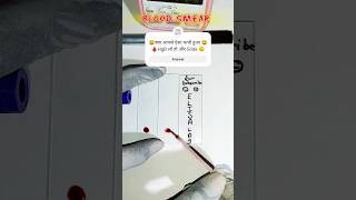 😞Blood Smear Preparation 🩸bloodsmear shortsvideo laboratory medical [upl. by Male571]