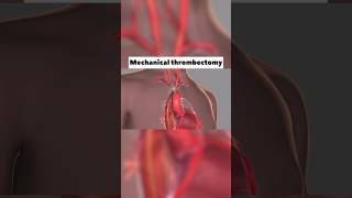 Mechanical Thrombectomy￼ [upl. by Pat]