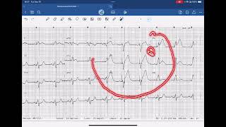 Sgarbossa Criteria Example Paced Rhythm [upl. by Torrance772]