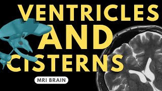 Ventricles and Cisterns of the Brain  Radiology anatomy part 1 prep  MRI brain [upl. by Eigger]