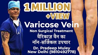 Varicose vein treatment procedure MicrowaveRFALaser Ablation Surgery [upl. by Victor]