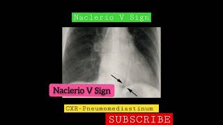 CXR sign  Naclerio V Sign  Pneumomediastinum [upl. by Tloh975]