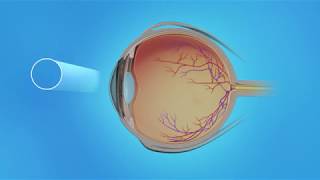 Retinal Tear Treatment  Laser Photocoagulation [upl. by Boothe]