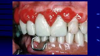 Fall 2020 Periodontology 1 Lec 8 Influence of systemic diseases and disorders on the periodontium [upl. by Tiphany]