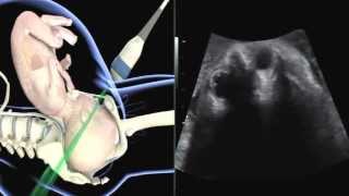 ISUOG how to perform ultrasound in labor assessment of fetal occiput position [upl. by Ethelinda747]