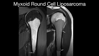 Myxoid Round Cell Liposarcoma [upl. by Bunnie]