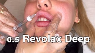 Russian Lips With Revolax Deep 11 ml only 05 [upl. by Yrreiht]