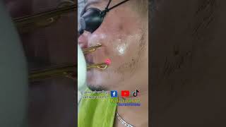 Acne scar CO2 laser treatment acnetreatment co2laser laser laserskincare bangladesh [upl. by Gault]