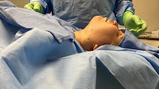 Liposuction of the neck plus skin tightening and fat transfer [upl. by Enelia]