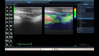 IQ 316 TFAST LUNG ULTRASOUND ECHOPAC ANALYSIS ELASTOGRAPHY [upl. by Jacobson]