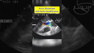 Aortic Dissection with Aortic Insufficiency echocardiography [upl. by Ainerol]