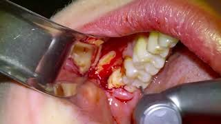 33 Live Surgery Impacted Wisdom Tooth Extractions [upl. by Adelpho]