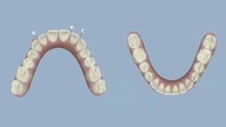 Invisalign  Midline Shift and IPR  Dr Thomas Gibbs DDS [upl. by Euginom]