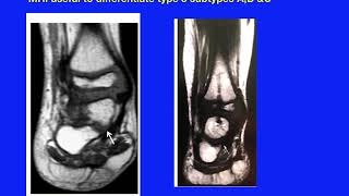 Fibular hemimelia 6 cases managed according tp Dr Paley reconstructive method [upl. by Wendall85]