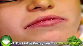 How Angular Cheilitis Cream Works [upl. by Azaria]