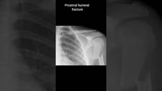 Proximal humeral fracture xrayshoulder [upl. by Andrei229]