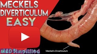 Meckels Diverticulum Made Easy [upl. by Russ428]