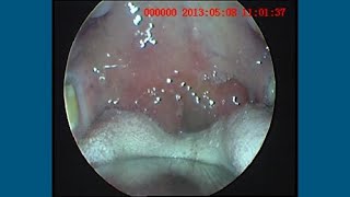 Peritonsillitis with Severe Uvula Oedema [upl. by Oniliuqnart]