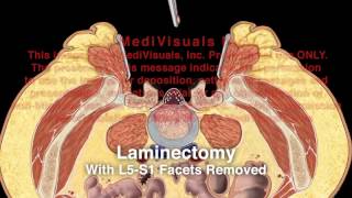 Spondylolisthesis Lumbar Repair [upl. by Leahcin]