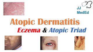 Eczema Atopic Dermatitis  Atopic Triad Triggers Who gets it Why does it happen amp Treatment [upl. by Alejna]