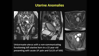 ISMRM MR Academy  Endometrial and Cervical Cancer [upl. by Mor]