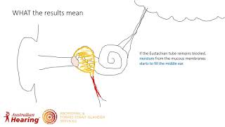 Tympanometry Training Refresher [upl. by Ecilahs]