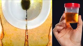 4 Reasons Why Your Urine is Dark in Color [upl. by Nnylram11]