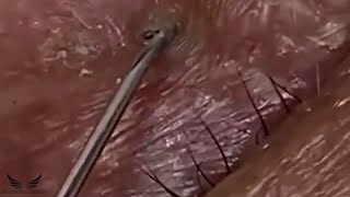 Severe Eye Blackhead Removal  Acne Cystic Treatment  Pimple Popping Elderly Acne Spa Remove  062 [upl. by Benildis]