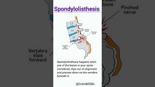 Spondylolisthesis  viralshorts spondylolisthesis vertebrae spinalcord [upl. by Robma]