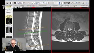 Clinical Series Lumbar Spinal Stenosis on MRI [upl. by Eintihw304]