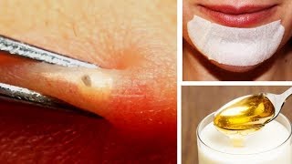 How to Remove Blackheads Around Mouth [upl. by Conlen]