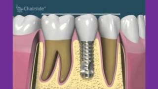 Periimplantitis y sobrecarga en implantes [upl. by Ahset]