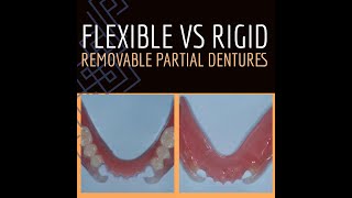 V2538 Flexible vs Rigid Removable Partial Dentures [upl. by Yennek]