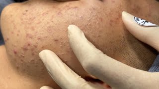 Blackheads amp Pimples Pore Removal New 2024FULL  Acne Treatment With Bo Nguyễn Spa [upl. by Niletac136]