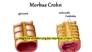 Tägliche Ernährung bei Morbus Crohn [upl. by Tedda789]