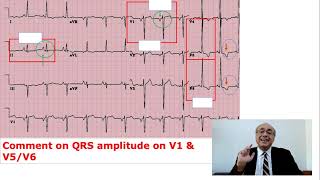 EKG Trainer Case 5 Questions [upl. by Rosabel]