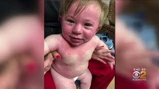 Child Has Anaphylactic Reaction To Paint With DairyBased Ingredients [upl. by Arim773]