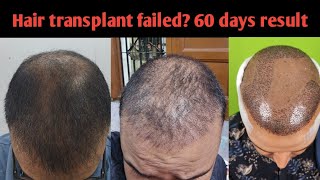 My hair transplant result after 2 months My hair failed [upl. by Eerac217]