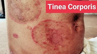 Understanding and Treating Tinea Corporis Expert Guide [upl. by Lemcke]