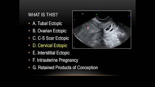 First trimester obstetrical ultrasound part 2 usual locations of ectopic pregnancy [upl. by Rodrique]