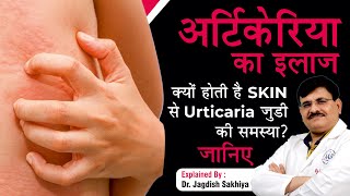 Urticaria Hives Causes Symptoms amp Treatment  In Hindi   Dr Jagdish Sakhiya Skin Clinic [upl. by Tera304]