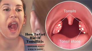 Sign of Tonsillitis Causes Symptoms and Treatment  How To Get Rid Of Tonsillitis [upl. by Base]