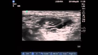 ultrasound guided combined femoral nerve blocksciatic nerve blockLFCN [upl. by Bury152]