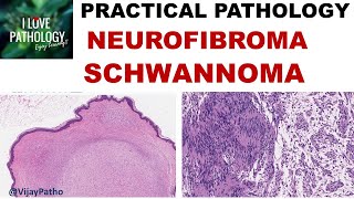 NEUROFIBROMA AND SCHWANNOMA Clinical features amp Morphology [upl. by Yurt871]