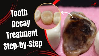 Restoration of a Massive Tooth Decay [upl. by Eiryk]