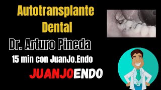 Autotransplante dental 15 min con JuanJoEndo [upl. by Currier]